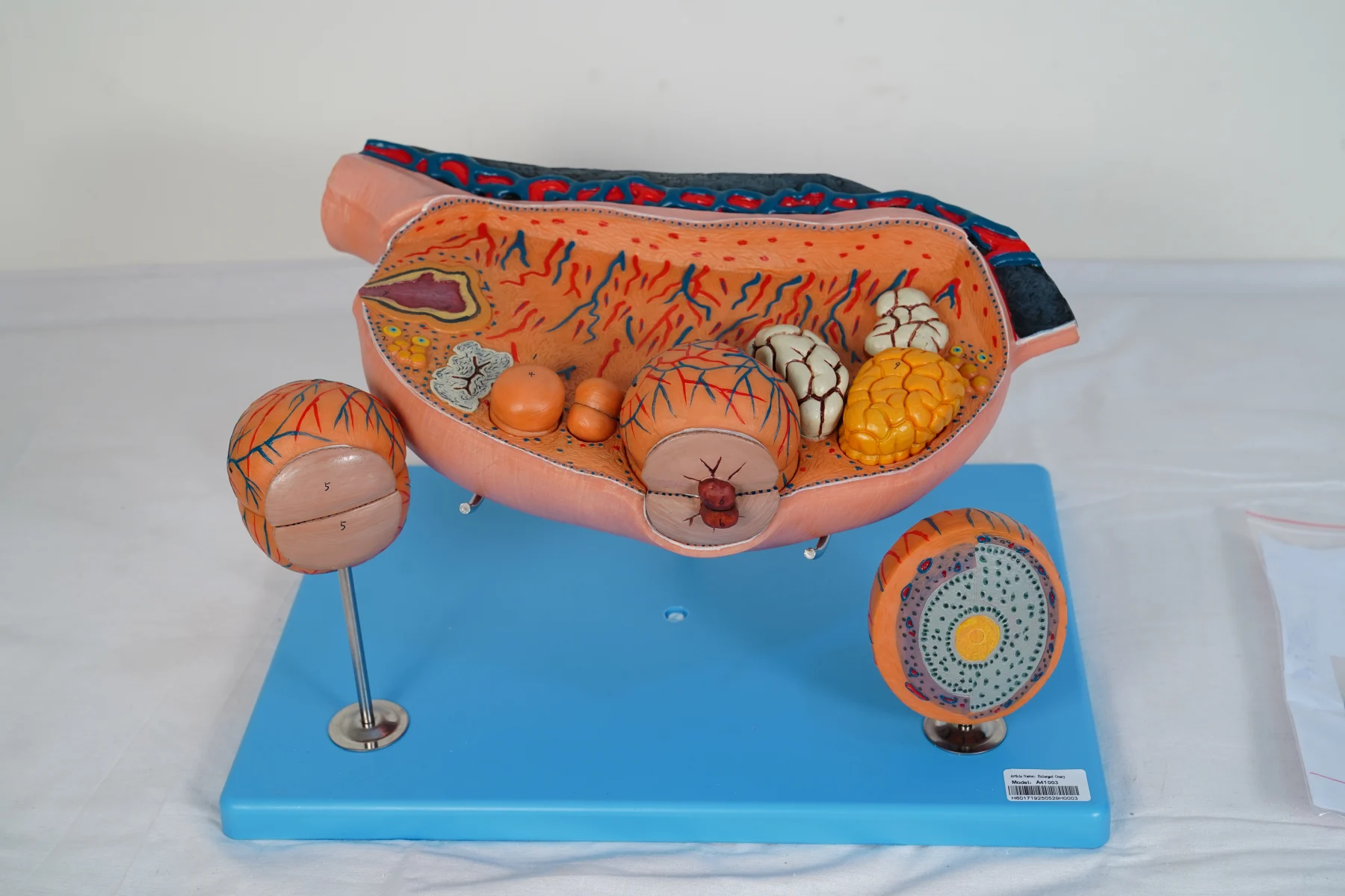 Enlarged Ovary thumbnail 5