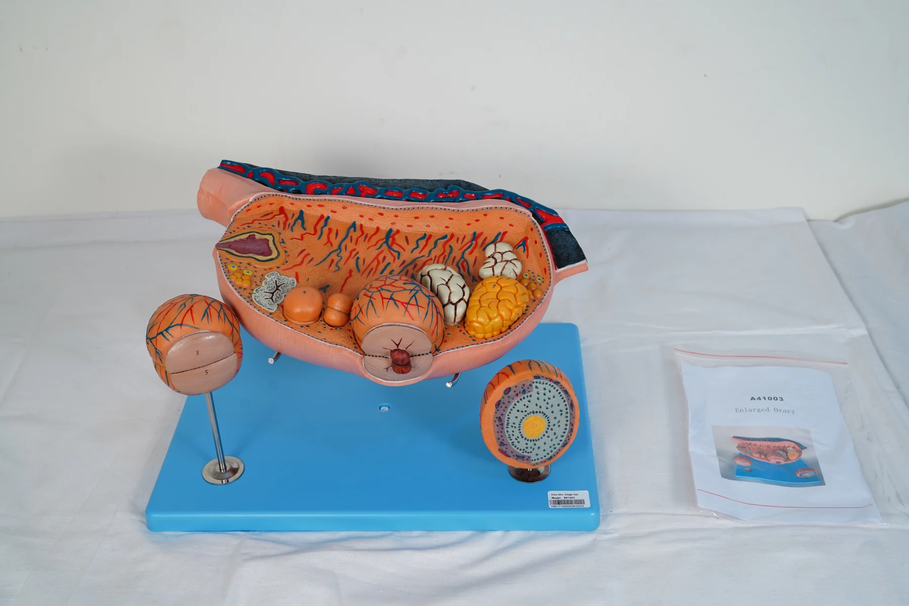 Enlarged Ovary