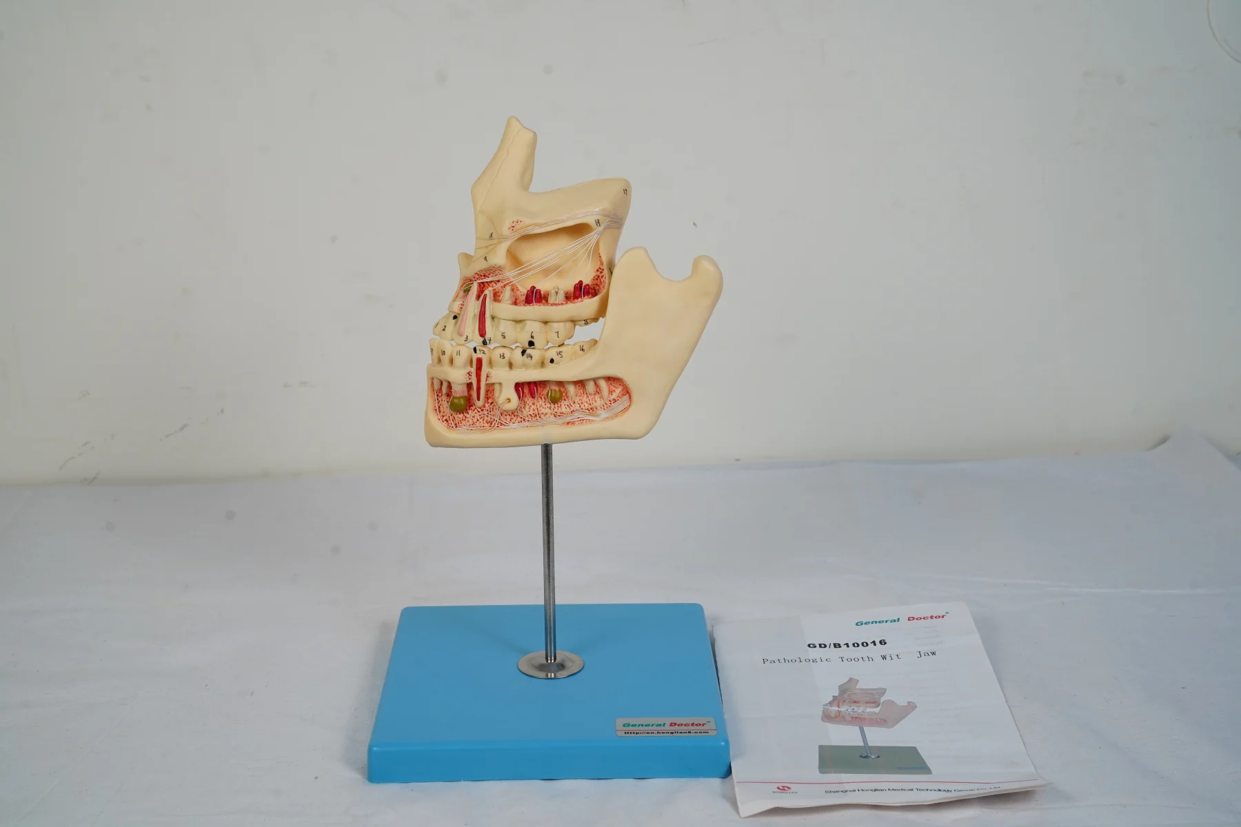 Pathologic Tooth With Jaw thumbnail 3