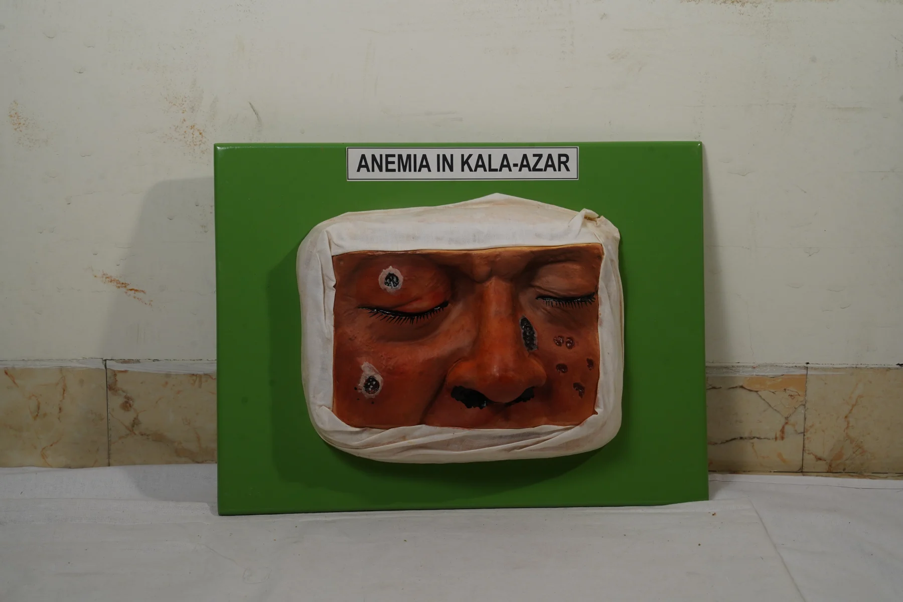 Anemia In Kala Azar thumbnail 3