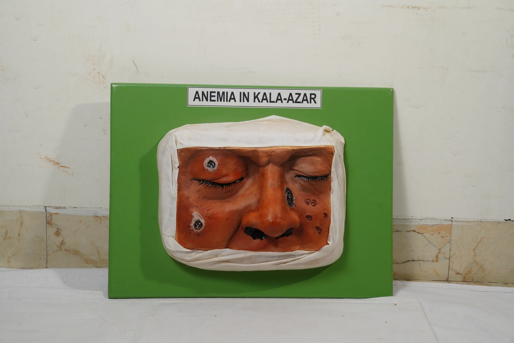 Anemia In Kala Azar