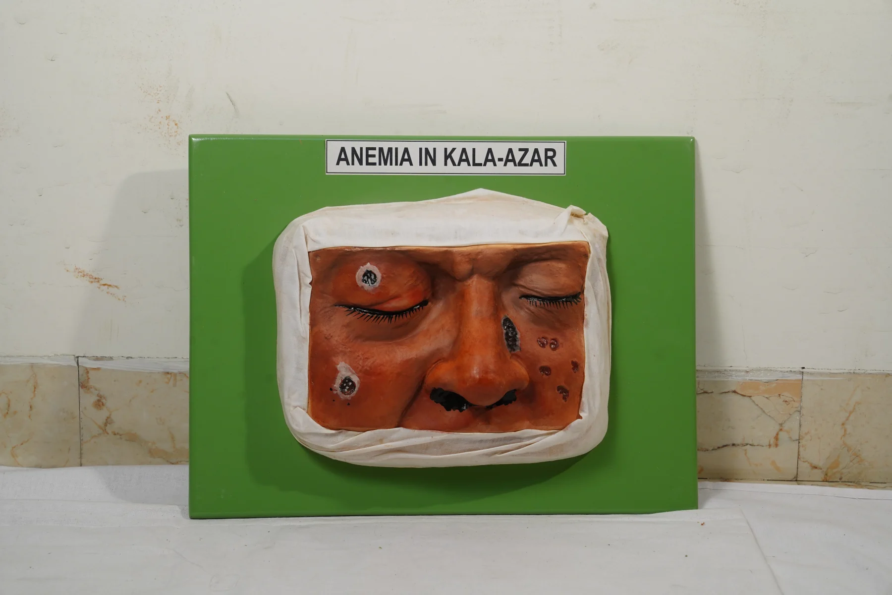 Anemia In Kala Azar thumbnail 2
