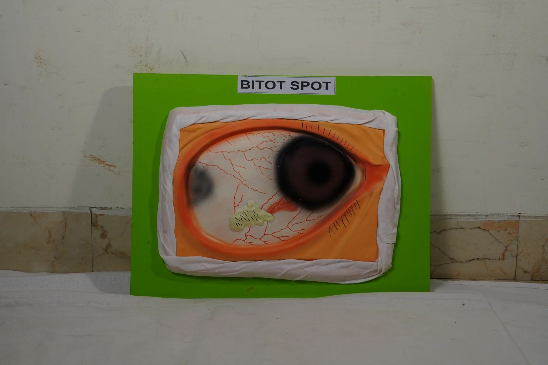 Bitot Spot thumbnail 3