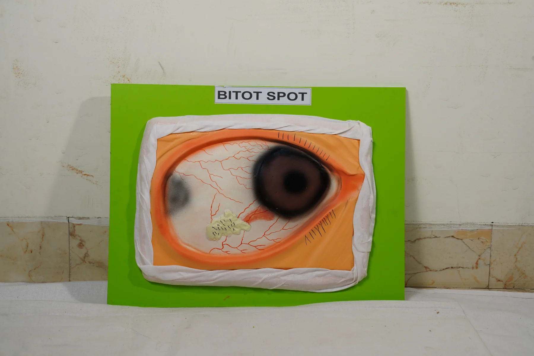 Bitot Spot