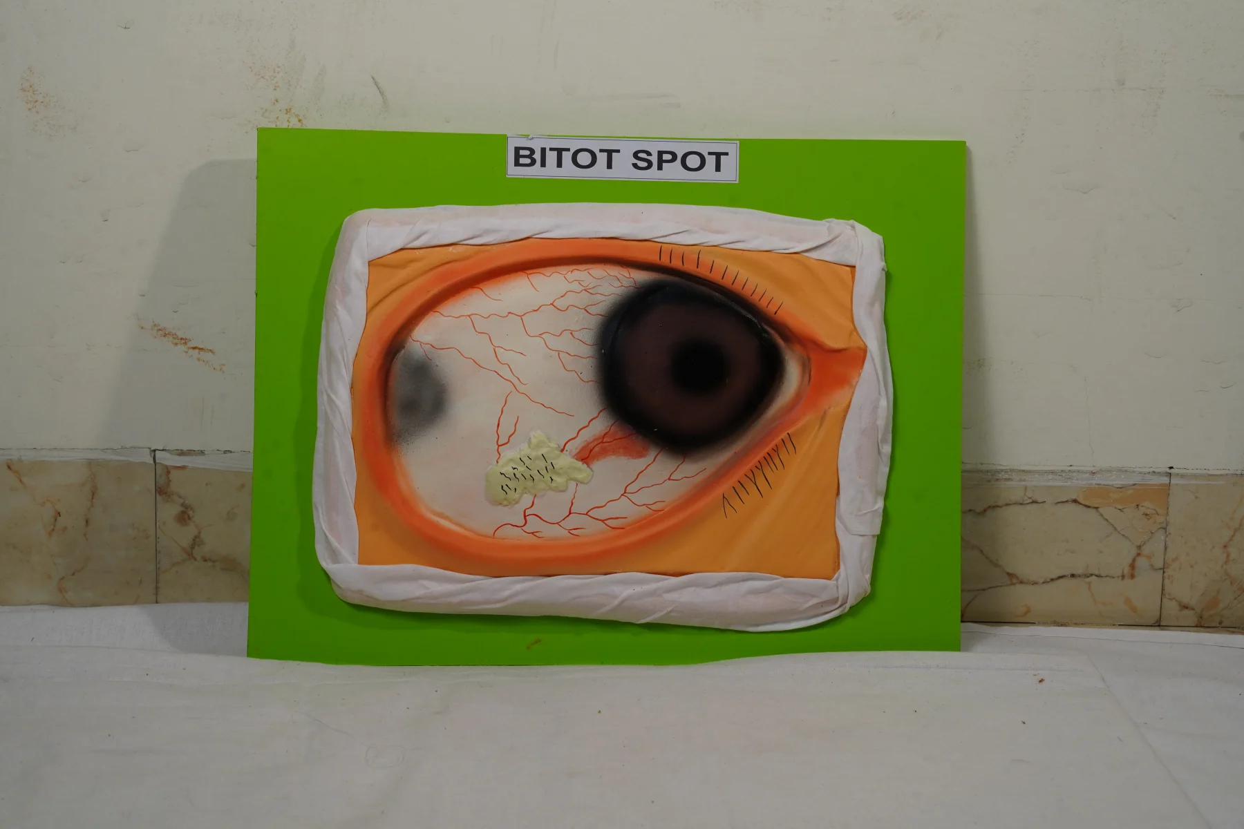 Bitot Spot thumbnail 2