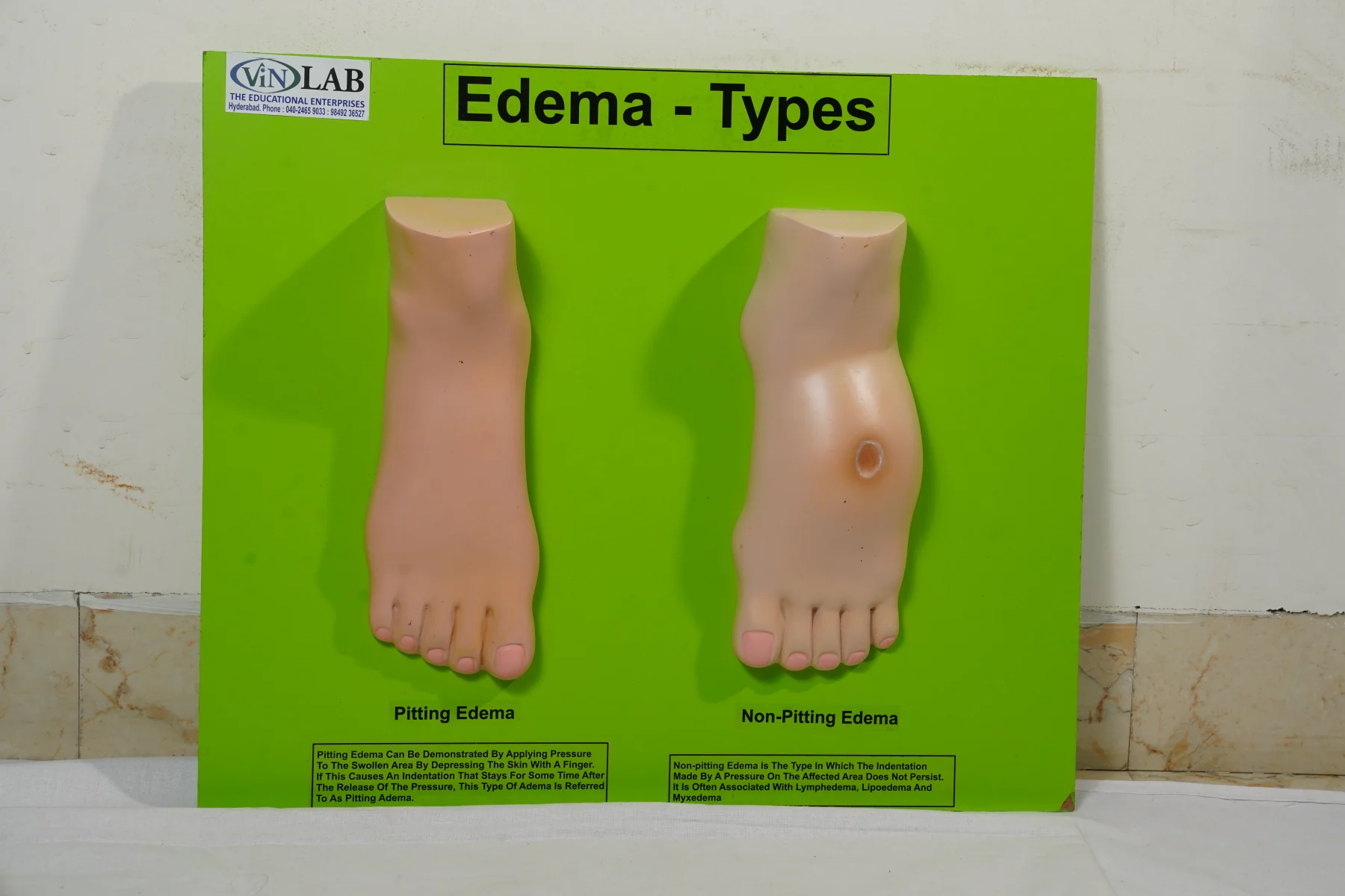 Edema Types