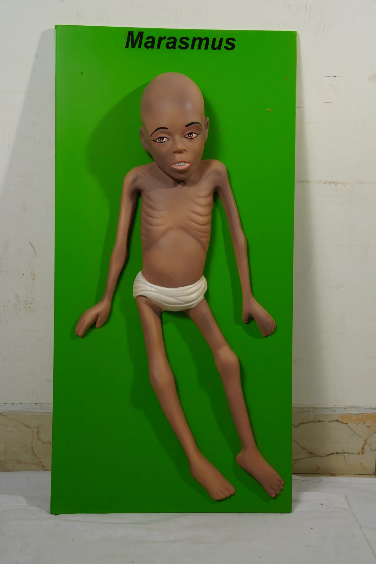 Marasmus