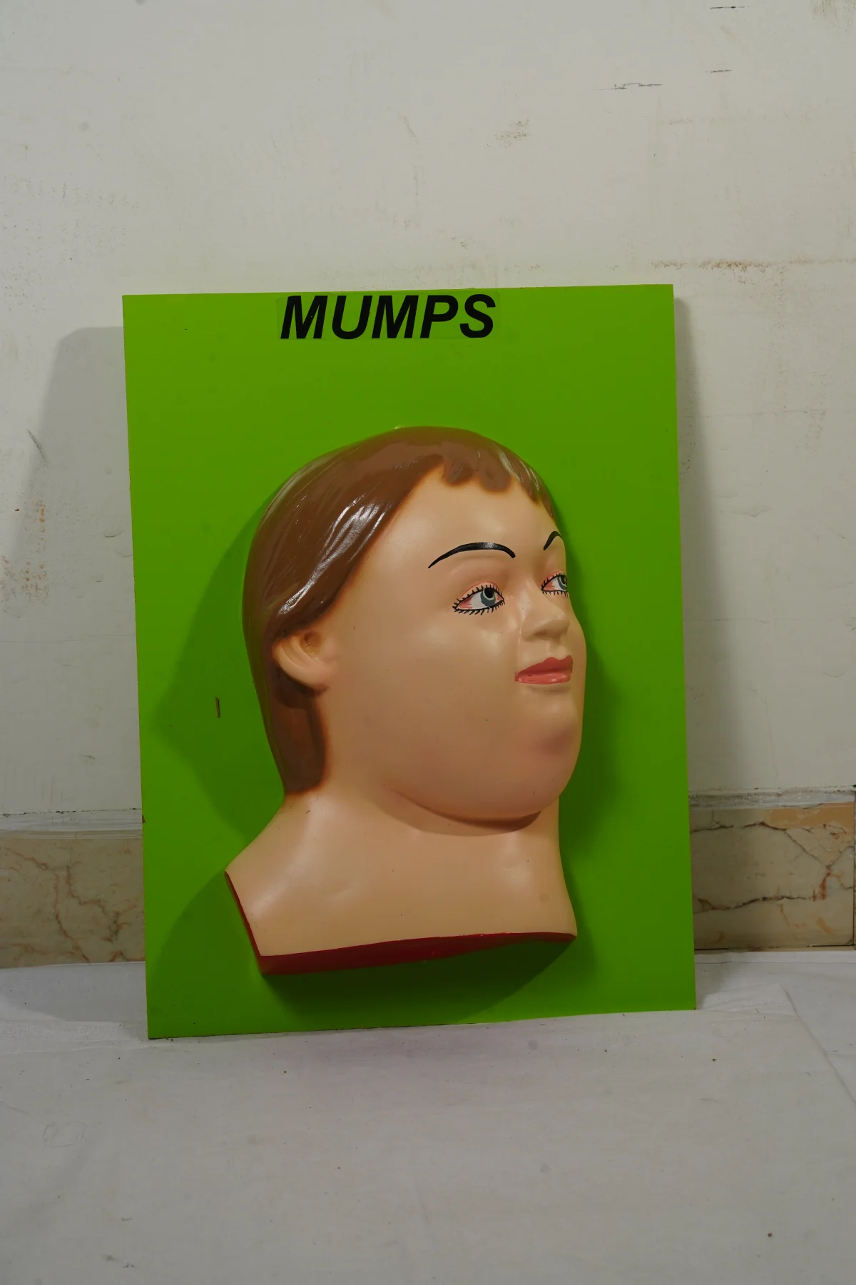 Mumps thumbnail 3