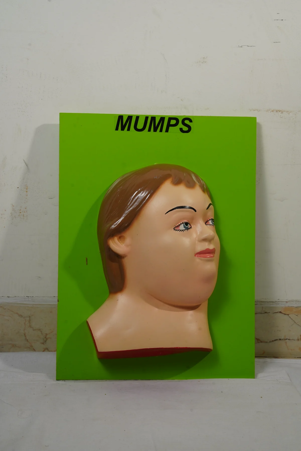 Mumps thumbnail 2