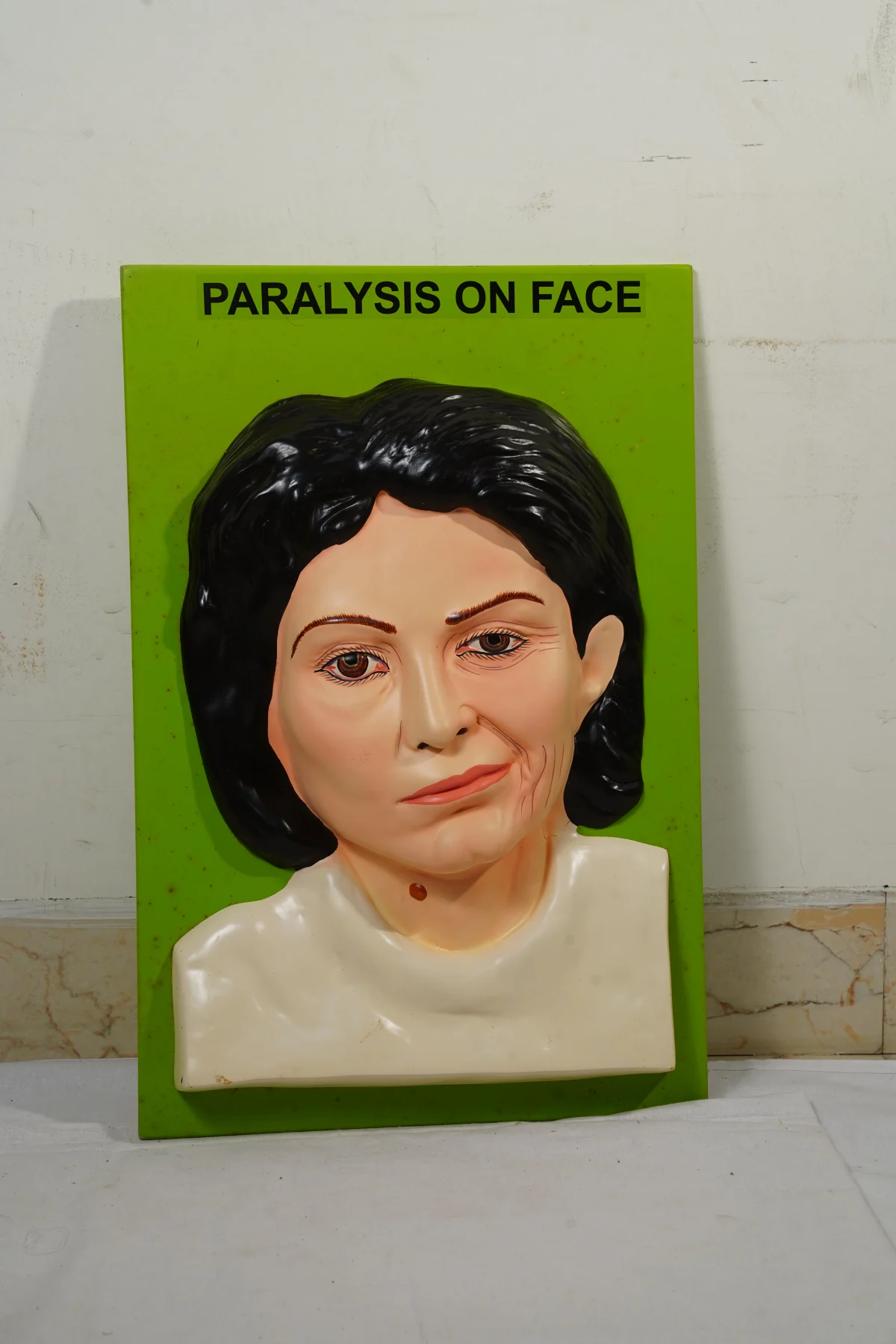 Paralysis On Face thumbnail 2