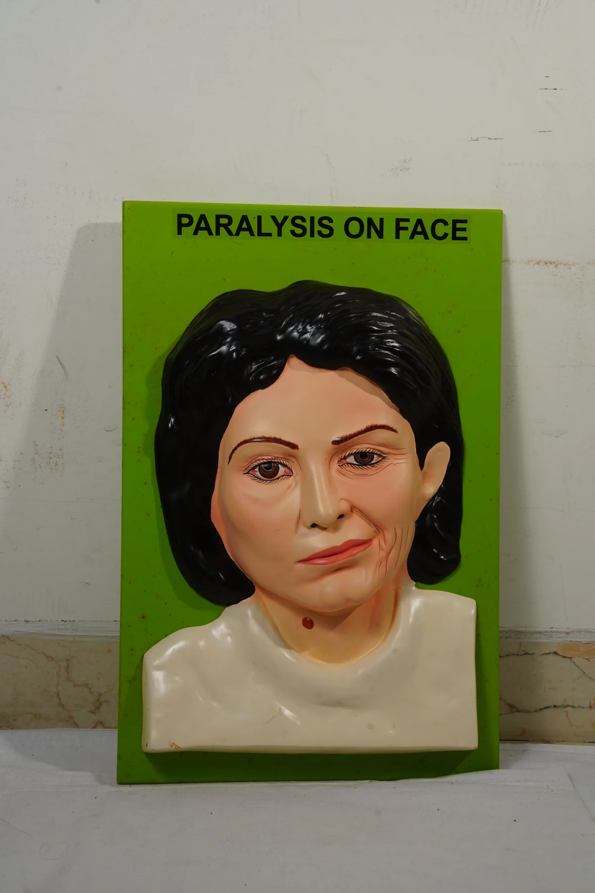 Paralysis On Face