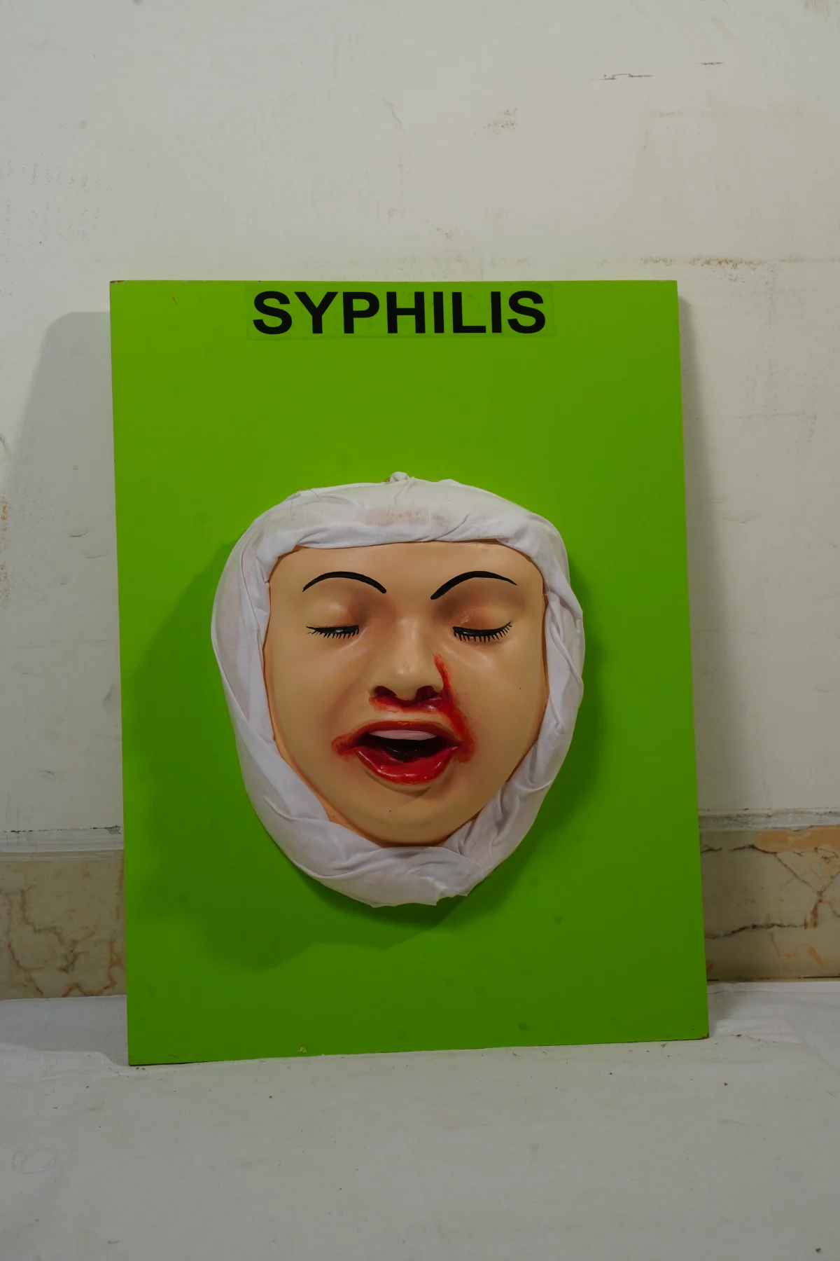 Syphilis thumbnail 3