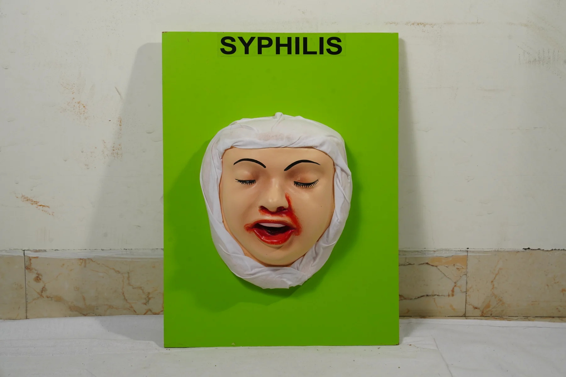 Syphilis thumbnail 2
